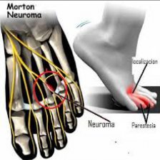 INTERVENCIN QUIRRGICA DE NEUROMA DE MORTON