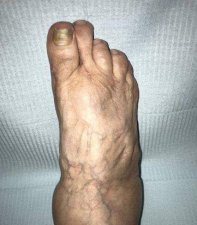 CIRUGA DE HALLUX VARUS IATROGNICO