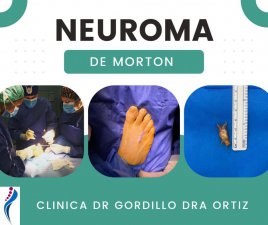 CIRUGA DE NEUROMA DE MORTON